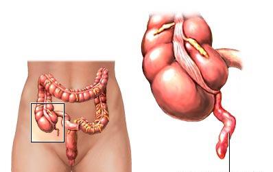 síntomas de apendicitis crónica 